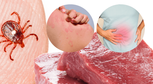 Tick bite with meat and some associated symptoms of Alpha-Gal syndrome